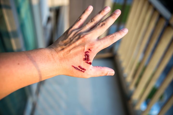 A close-up of a hand with fresh scratches and dried blood across the back. The hand is extended with fingers spread, and a balcony railing is visible in the blurred background.